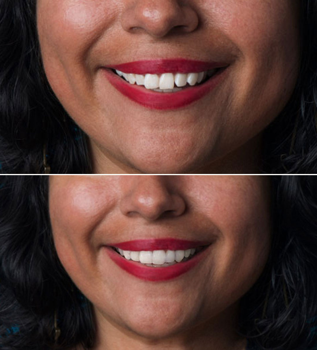 Invisalign before after image Invisalign before after image