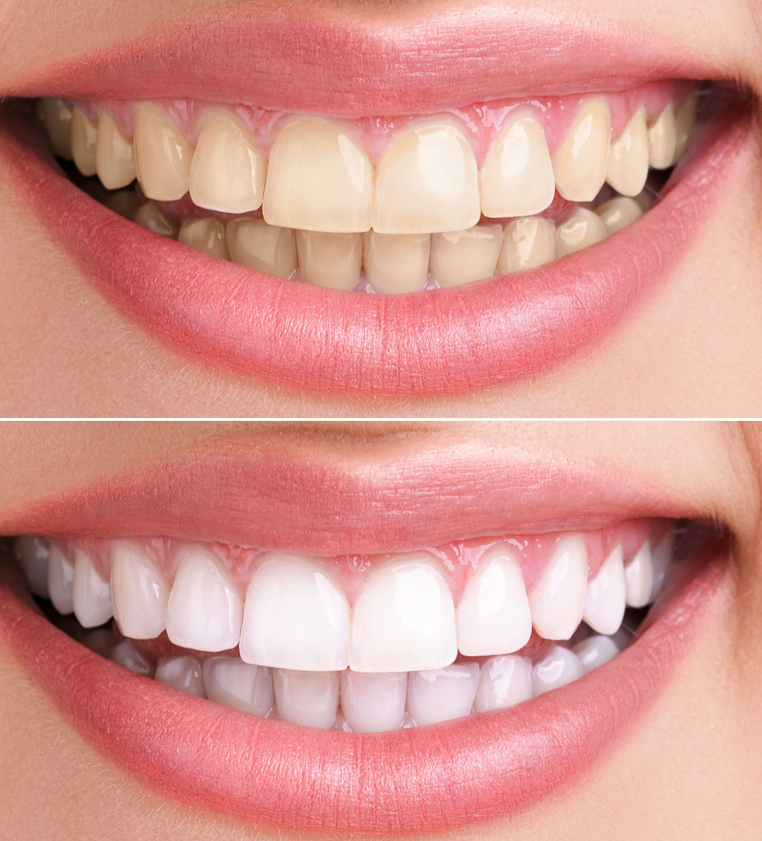 Cosmetic Dentistry before after image Cosmetic Dentistry before after image