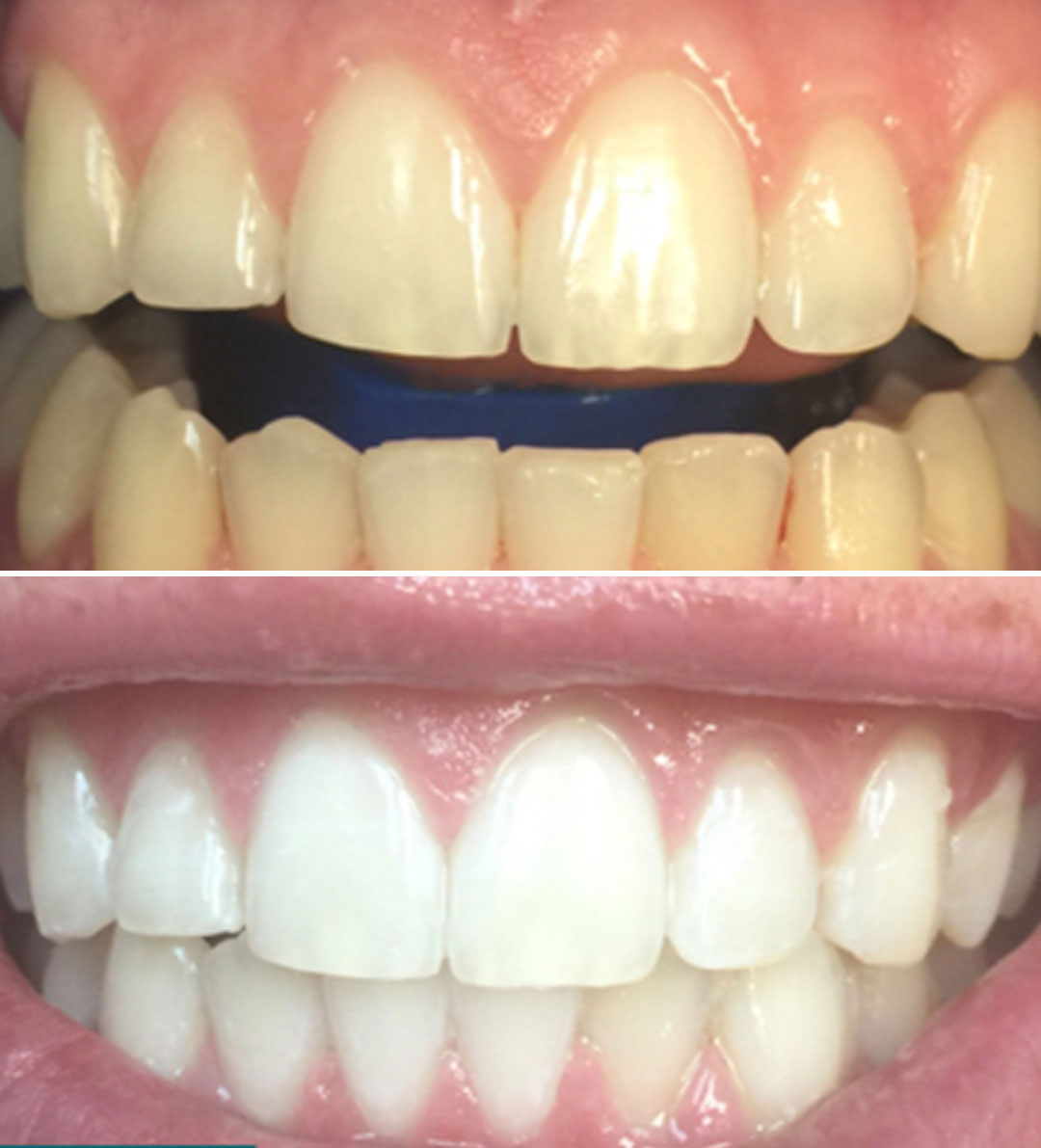 Teeth Whitening before after image Teeth Whitening before after image